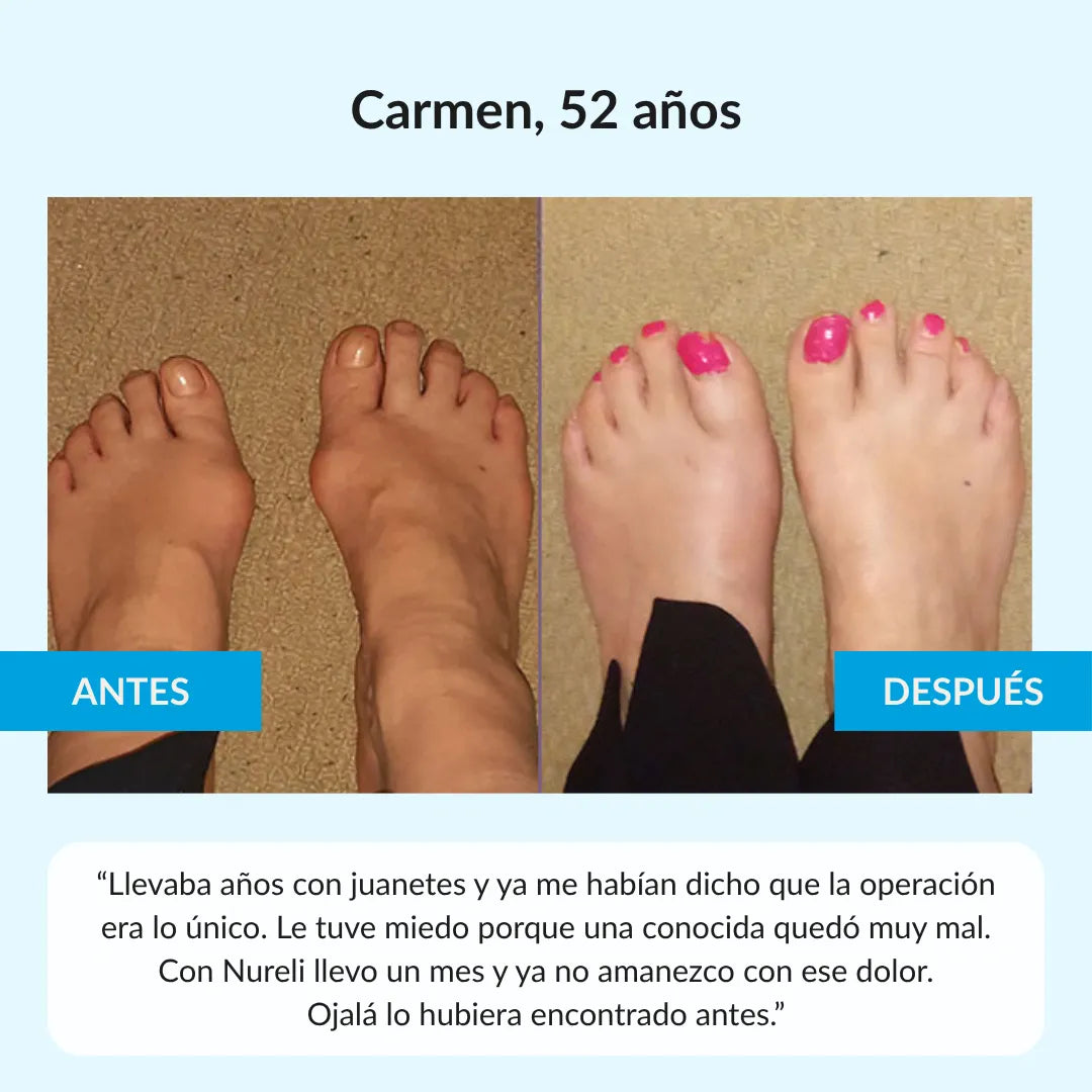 Nuleri™ - Corrector de Juanetes