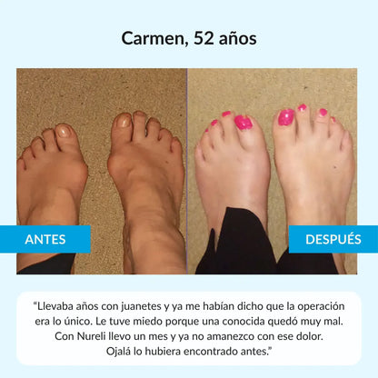 Nuleri™ - Corrector de Juanetes