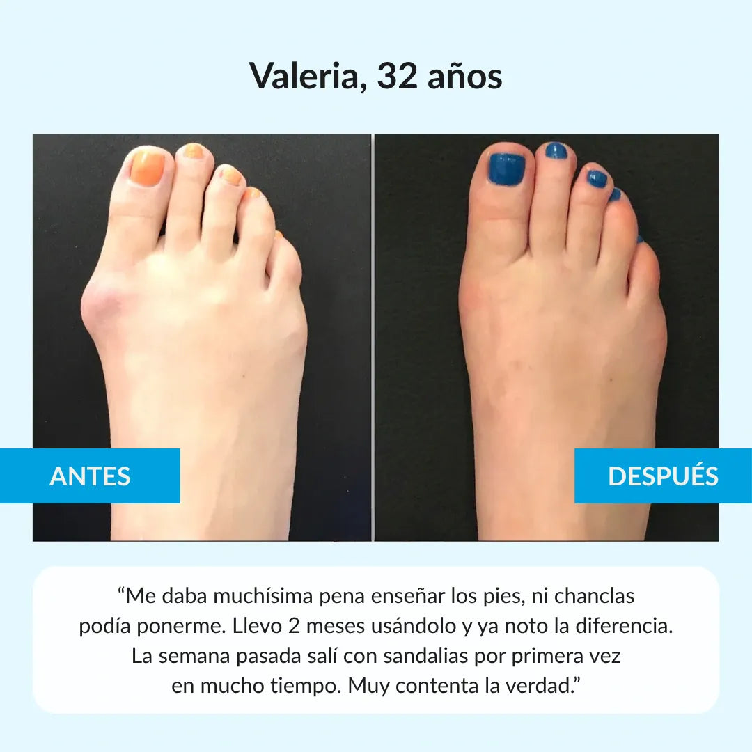 Nuleri™ - Corrector de Juanetes