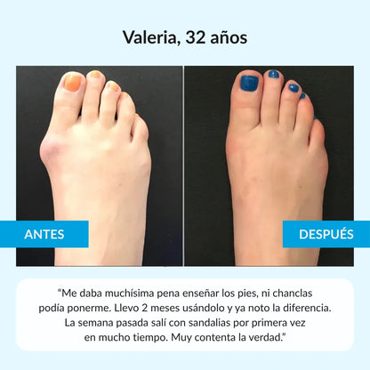 Nuleri™ - Corrector de Juanetes